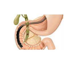 ERCP Treatment